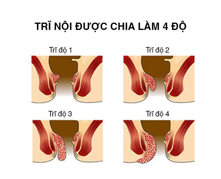 trĩ nội