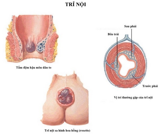 biểu hiện trĩ nội độ 2