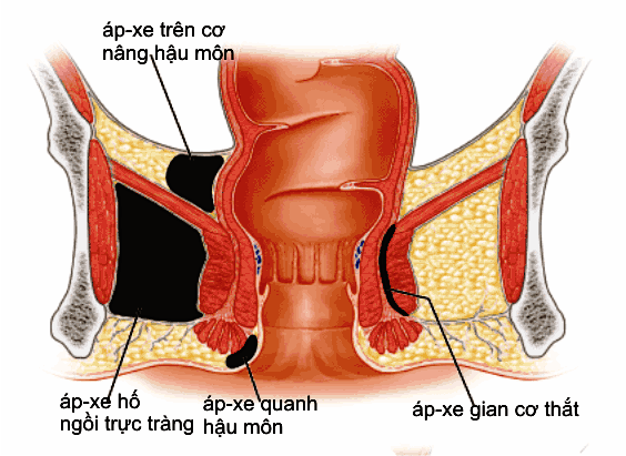 apxe-hau-mon-va-nguyen-nhan-phat-sinh