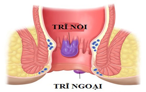 trĩ nội trĩ ngoại là gì