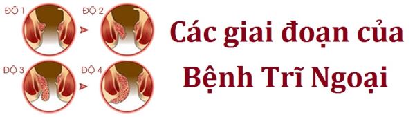 các giai đoạn bệnh trĩ ngoại 