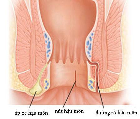 benh-ro-hau-mon-co-nguy-hiem-khong-1