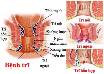 benh-tri_9