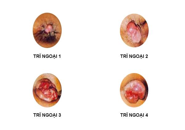 cấp độ trĩ ngoại_1