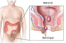 Cách trị bệnh trĩ ngoại