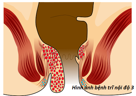 biểu hiện bệnh trĩ ngoại độ 3