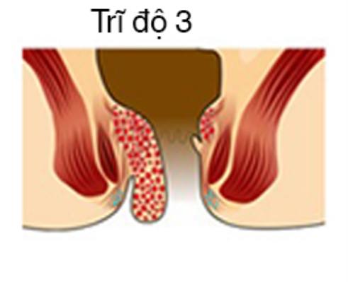 Trĩ hỗn hợp độ 3 có nguy hiểm không?