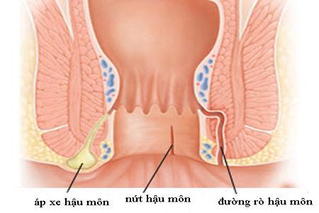 áp xe hậu môn