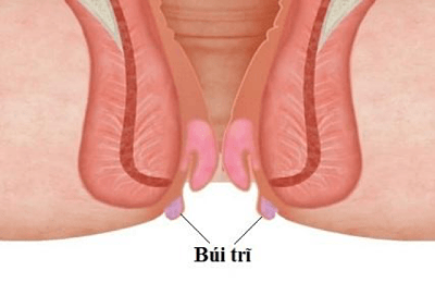 TRĨ