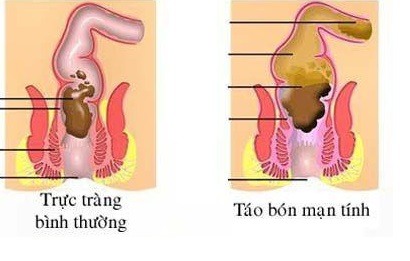 nhung-cach-chua-tao-bon-hieu-qua-benhduongtieuhoa2