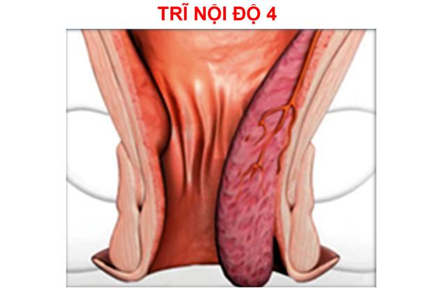 nguy hại từ trĩ nội độ 4