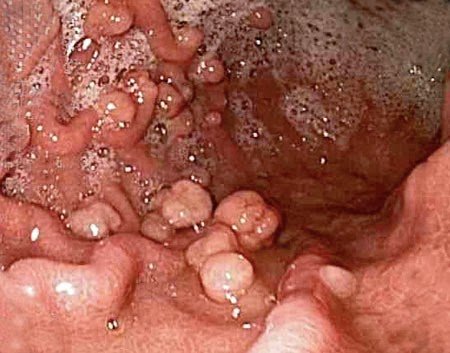 nguyen-nhan-gay-polyp-hau-mon