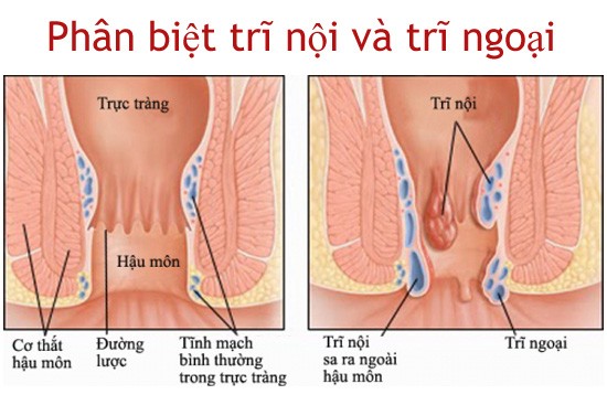 phân biệt trĩ nội trĩ ngoại