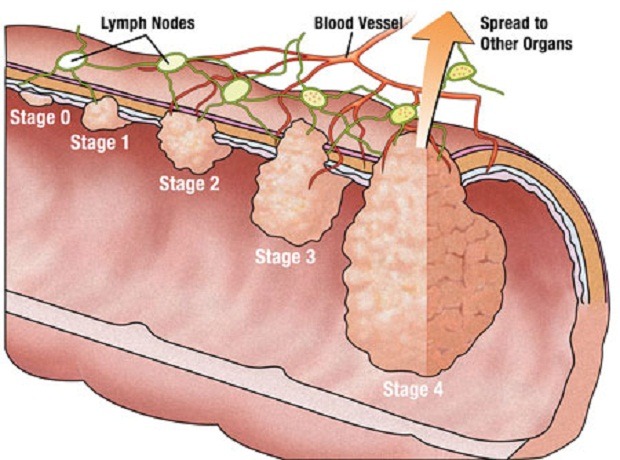 polyp-truc-trang