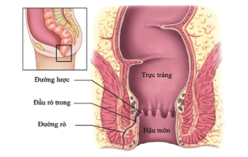 rò hậu môn