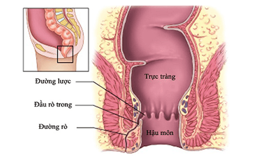 rò hậu môn_1