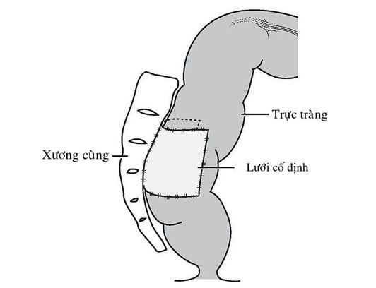 sa trực tràng