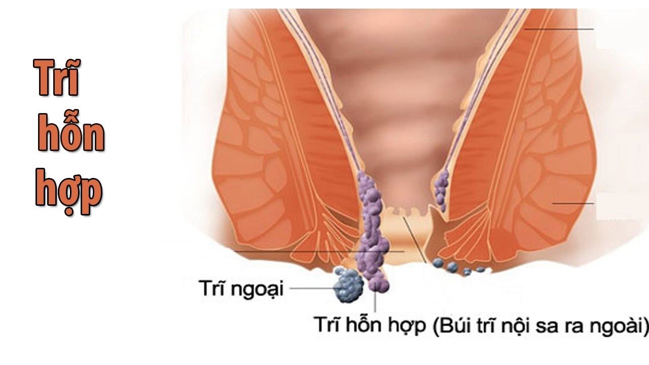 tri hon hop 0_1