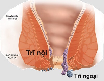 bệnh trĩ nội trĩ ngoại