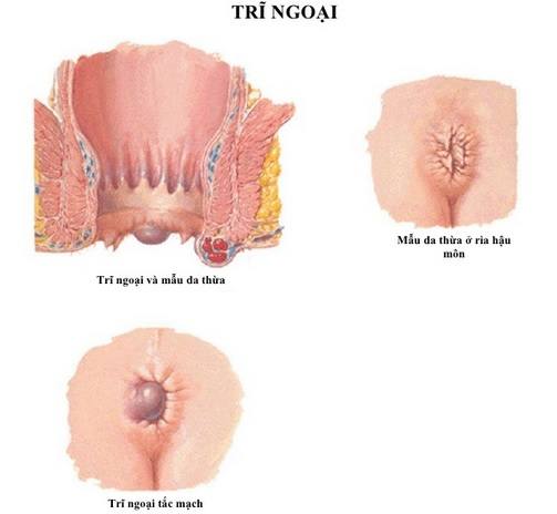 trĩ ngoại độ 1