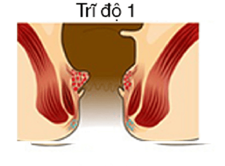 bệnh trĩ nội độ 1