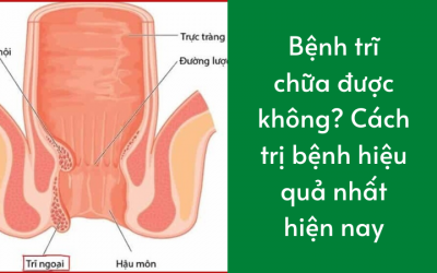 Bệnh Trĩ Chữa Được Không? Cách Trị Bệnh Hiệu Quả Nhất Hiện Nay