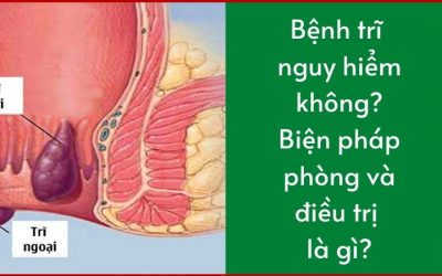 Bệnh Trĩ Có Nguy Hiểm Không Biện Pháp Phòng Và Điều Trị Là Gì?