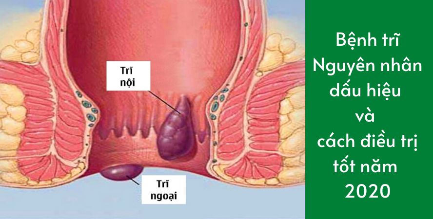 Bệnh trĩ : Nguyên nhân dấu hiệu và cách điều trị tốt năm 2025