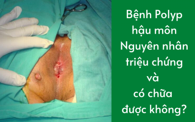 Bệnh Polyp hậu môn: Nguyên nhân, triệu chứng và có chữa được không?
