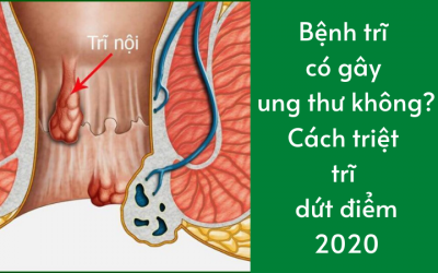 Bệnh trĩ có gây ung thư không? Cách triệt trĩ dứt điểm