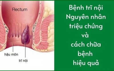Bệnh trĩ nội: Nguyên nhân triệu chứng và cách chữa bệnh hiệu quả