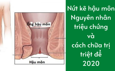 Nứt kẽ hậu môn: Nguyên nhân, triệu chứng và cách chữa trị triệt để