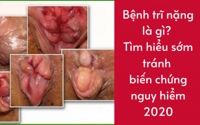 Bệnh trĩ nặng là gì? Tìm hiểu sớm tránh biến chứng nguy hiểm