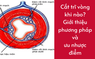 Cắt trĩ vòng khi nào? Giới thiệu phương pháp và ưu nhược điểm của nó