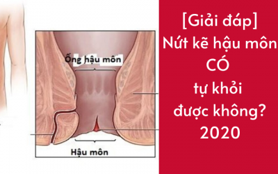 [Giải đáp] Nứt kẽ hậu môn có tự khỏi được không?