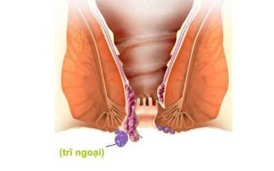 Danh sách 5+ cách chữa bệnh trĩ ngoại tại nhà