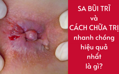 Sa Búi Trĩ Và Cách Chữa Trị Nhanh Chóng Hiệu Quả Nhất Là Gì?