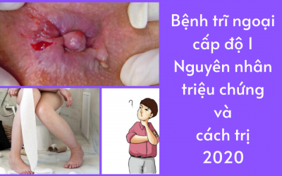 Bệnh trĩ ngoại cấp độ 1 – Nguyên nhân triệu chứng và cách trị