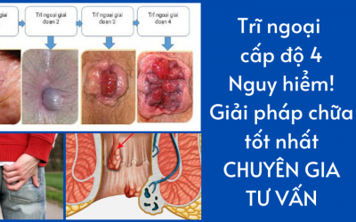 Trĩ ngoại cấp độ 4 – Nguy hiểm! Giải pháp chữa tốt nhất