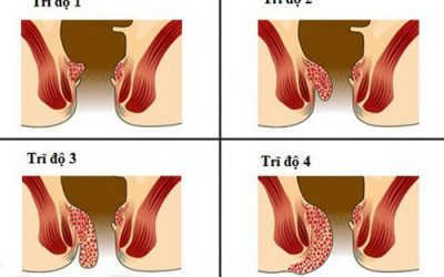 Bệnh Trĩ Nội Có Nguy Hiểm Không? Phương Pháp Điều Trị Trĩ Nội
