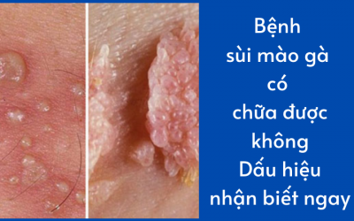 Bệnh sùi mào gà có chữa được không: Dấu hiệu nhận biết ngay