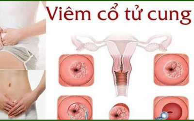 Cách chữa viêm lộ tuyến cổ tử cung nào đem lại hiệu quả tốt nhất?