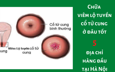 Chữa viêm lộ tuyến cổ tử cung ở đâu tốt: Top 5 địa chỉ hàng đầu tại Hà Nội
