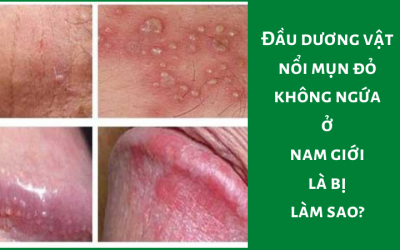 Đầu dương vật nổi mụn đỏ không ngứa ở nam giới là bị làm sao?