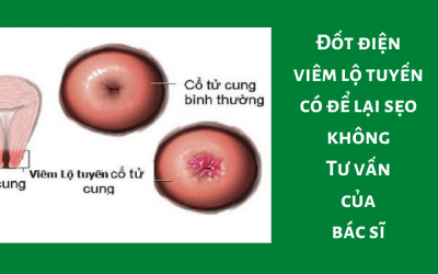 Đốt điện viêm lộ tuyến có để lại sẹo không: Tư vấn của bác sĩ