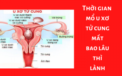 Thời gian mổ u xơ tử cung mất bao lâu thì lành