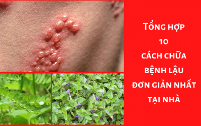 Tổng hợp 10 cách chữa bệnh lậu đơn giản nhất tại nhà