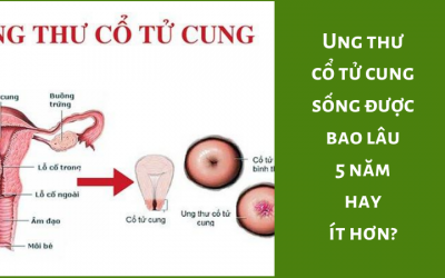 Ung thư cổ tử cung sống được bao lâu, 5 năm hay ít hơn?