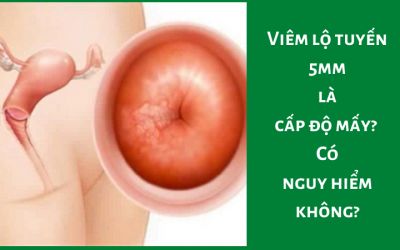 Viêm lộ tuyến 5mm là cấp độ mấy? Có nguy hiểm không?