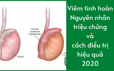 Viêm Tinh Hoàn: Nguyên Nhân, Triệu Chứng Và Cách Điều Trị Hiệu Quả